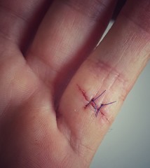 Cicatriser suture © shocky