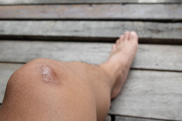 scar on knee