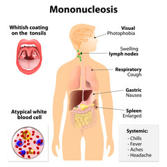 infectious mononucleosis - obrazy, fototapety, plakaty