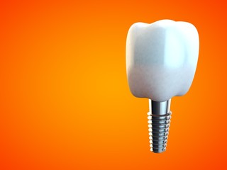 Tooth molar implant Dental Hygiene Dentist 3D orange