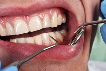 patient open mouth