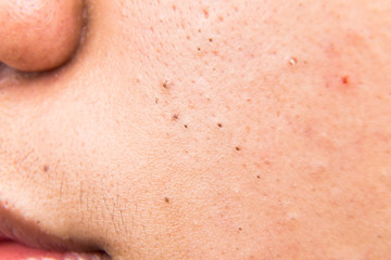 Close up on ugly acne, pimples, zit, blackheads on cheek of a teenager