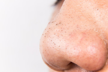 Fototapeta premium Ugly pimples, acne, zit and blackheads on the nose of a teenager