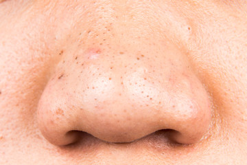 Ugly pimples, acne, zit and blackheads on the nose of a teenager