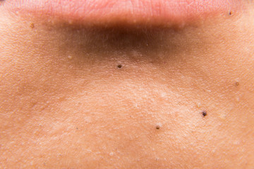 Fototapeta premium Close up on ugly acne, pimples, zit, blackheads on lips of a teenager