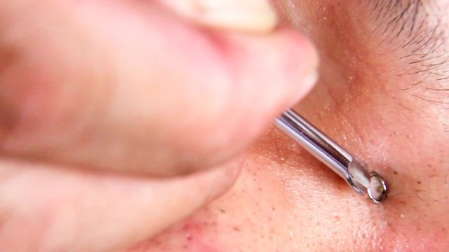 Squeezing pimple blackheads  teenager nose with pimple popper tool