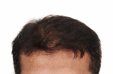 hair loss, Male head with hair loss symptoms front side