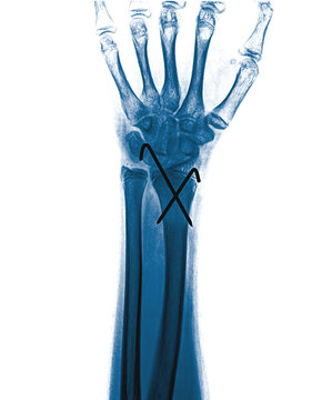 Xray imaging of epiphysial radial fracture of wrist reduced with permanent synthetic means