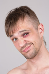 Man with an injured eye. Closeup.
