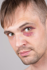 Man with an injured eye. Closeup.