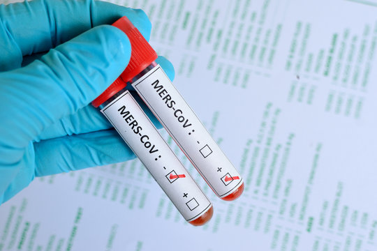 Blood sample with MERS-CoV positive and negative