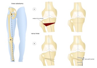 correzione chirurgica del ginocchio varo, osteotomia