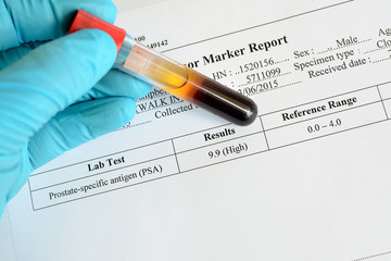 Blood sample with PSA high result