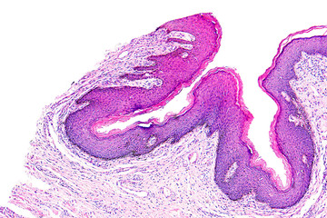 Skin papilloma of a human, highly detailed segment of panorama. Photomicrograph as seen under the...