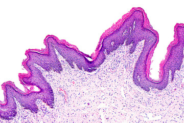 Skin papilloma of a human, highly detailed segment of panorama. Photomicrograph as seen under the microscope, 10x zoom.