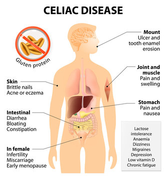 Coeliac disease or celiac disease