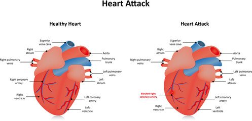 Heart Attack