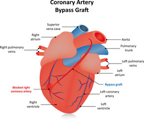 Coronary Artery Bypass Graft 