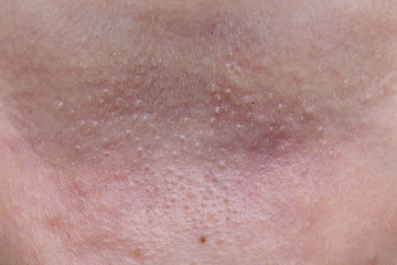 heat rash on the skin