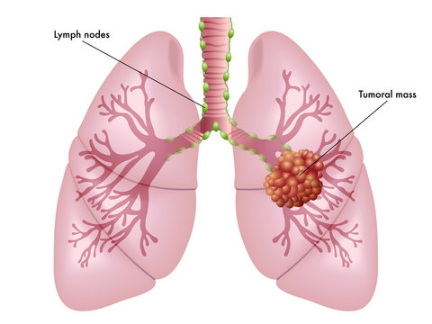 cancro del polmone