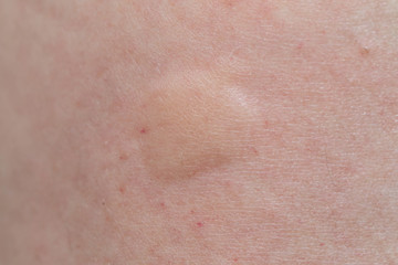 mosquito bites on a leg