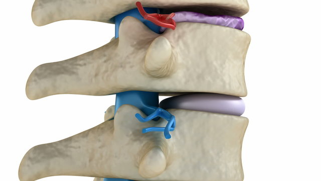 Spinal cord under pressure of bulging disc
