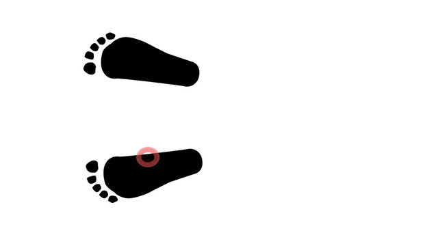 Flat feet - pes planus walking animation