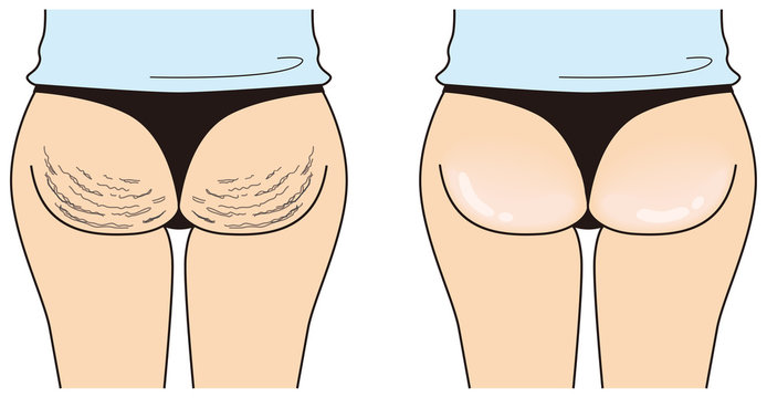 1 414 Best セルライト Images Stock Photos Vectors Adobe Stock