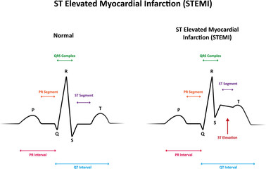 ST Elevated Myocardial Infarction