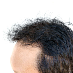 Point of focus lose one's hair glabrous baldy loss hairline men.