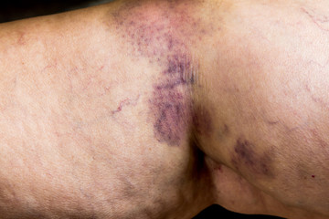 Naklejka premium Closeup on a Bruise on wounded old woman leg skin