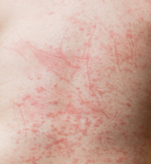 Red spots on baby's skin due to Dengue virus (Dengue hemorrhagic fever)
