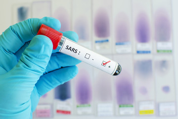 Fototapeta premium SARS virus positive