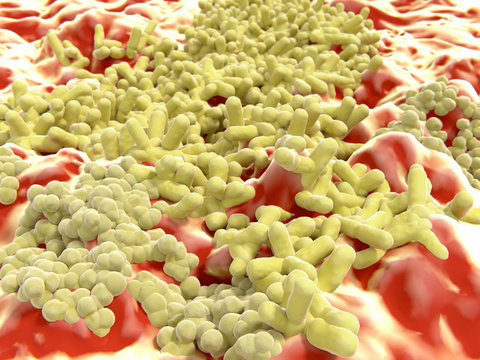 Multiresistente Bakterien, MRSA