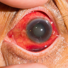 eye exam
