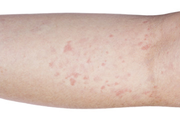 Allergic rash on arm