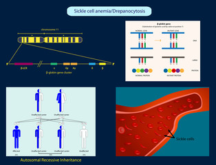 Sickle-cell anemia