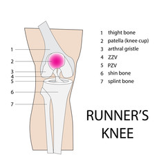 runners knee. vector illustration of knee injury with description