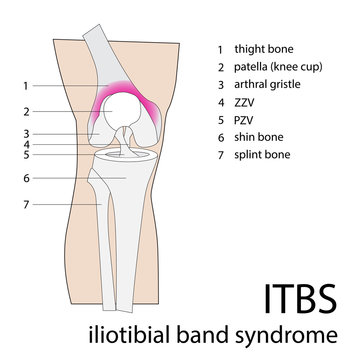 iliotibial band syndrome. vector illustration of itbs injury
