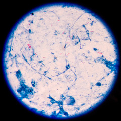 Microbacterium tuberculosis on sputum AFB.