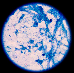 Microbacterium tuberculosis on sputum AFB.