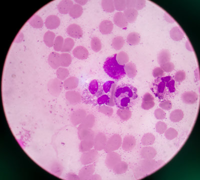 Abnormal neutrophil in pleural fluid smear.