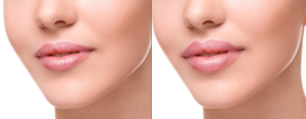 Lips  before and after augmentation - obrazy, fototapety, plakaty