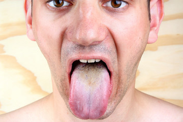 Bacterial infection disease tongue and herpes