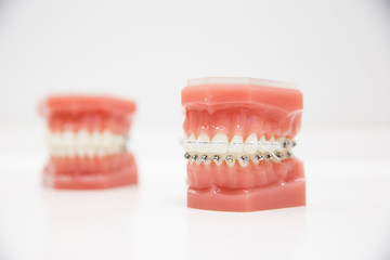 Model of human jaw with wire braces