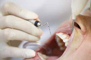 Periodontal probe for measuring pocket depths