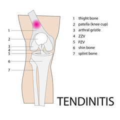 vector format illustration of tendinitis knee injury