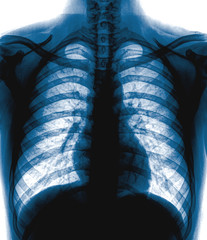 Close up detail of an x-ray of lungs