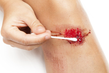 Cleaning bleeding wounds.Person with fresh bleeding wounds on the knees. Wound is cleaned with...