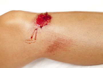Sport injury - painful knee wound accident. Close up on an bleeding scraped human knee after skating accident. Against white background, closeup, space for text